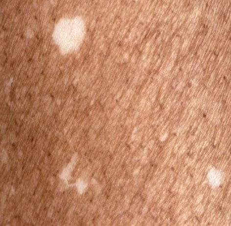 Dermatologia & Saú | Manchas na Pele
